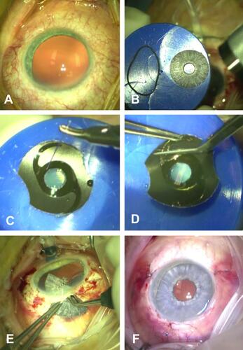 Figure 2 Implantation of an artificial iris in combination with an IOL: (A) Preoperative finding. (B) Trephination of the artificial iris and (C) suturing of the IOL onto the backside of the artificial iris. (D) Removal of the not required haptics. (E) Implantation of the folded combined implant through a 7 mm corneal-scleral incision in the ciliary sulcus. Fixation with non-resorbable 9–0 sutures in the 3 and 9 o’clock position. (F) Finding at the end of surgery.