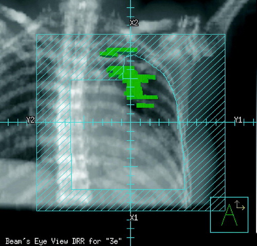 Figure 1B.  Frontal image (BEV) depicting the position of the frontal electron beam covering the chest wall and the IMN. Barred areas are shielded. Green areas represent regions with post-RT density changes.
