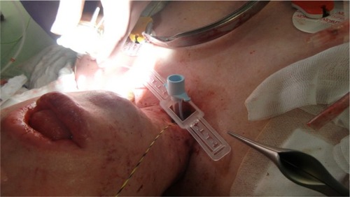 Figure 15 Introduction of a regular tracheal cannula through the new stoma.