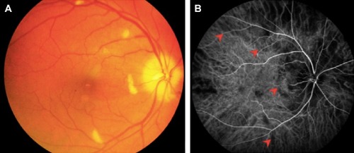 Figure 1 (A) Fundus photograph at presentation of patient 2 shows “chalky white” pallid disc edema with multiple cotton wool spots away from optic disc. (B) Indocyanine green angiography at 25 seconds shows multiple areas of choroidal non-perfusion (arrow heads).