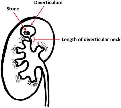 Figure 3 The length of the diverticular neck was measured from the opening to the diverticulum.