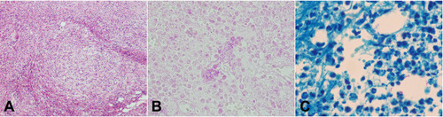 Figure 3 The histopathological results showed superficial and deep granulomatous dermatitis with suppuration, multinucleated giant cells (A); negative periodic acid Schiff (PAS) staining (B); acid-fast bacilli were seen on skin biopsy stained with Ziehl–Neelsen stain (C).