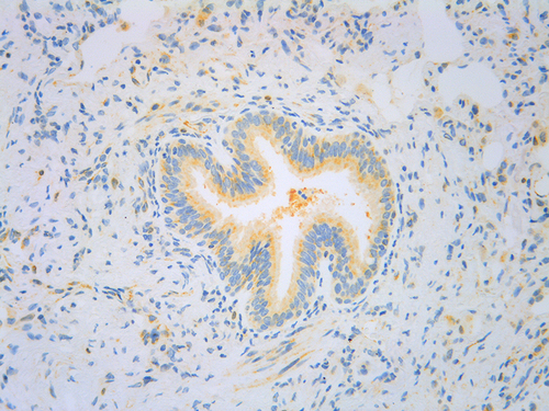 Figure 2 Histopathological staining for TSLP (yellow) in asthmatic bronchiolar epithelial and stromal cells.