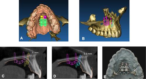 Figure 15 Positioning of virtual model of additional anterior bushings and miniscrews on the patient integrated model. (A) Occlusal view. (B) ¾ view. (C) Sagittal section, measurement of bone thickness at the level of additional anterior right miniscrew. (D) Sagittal section, measurement of bone thickness at the level of additional anterior left miniscrew. (E) Finalized MSE appliance.