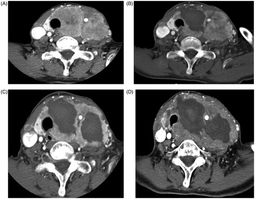 Figure 1. Radiofrequency ablation (RFA) of anaplastic thyroid carcinoma (A) Initial computed tomography (CT) image of an 80-year-old woman revealed 8 cm mass in the left thyroid gland with neck bulging and trachea deviation, proven as anaplastic thyroid carcinoma on core-needle biopsy. (B) Follow-up CT after first RFA (two days after initial RFA) revealed a 8.5 cm ablation zone with decreased enhanced portion of the mass. (C) Follow-up CT after second RFA (five days after initial RFA) revealed a 8.5 cm ablation zone. (D) On last follow-up CT after third RFA (39 days after initial RFA), CT revealed a 10 cm mass in the thyroid gland with unchanged neck bulging and trachea deviation.