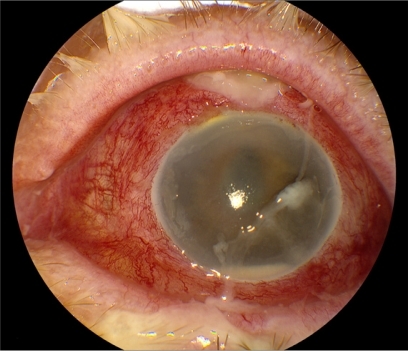 Figure 3 Photograph of left eye of 79-year-old female presenting with BAE from Streptococcus sp. Presenting VA: LP, IOP: 40 mmHg. Treatment: pars plana vitrectomy. Final VA: LP, IOP: 0 mmHg. Only 45% of Streptococcus cases had VA outcomes ≥ 20/400.