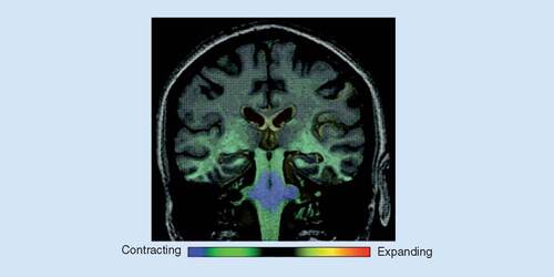 Figure 3. Fluid registration of serial MRI scans was used to demonstrate regional atrophy in one multiple system atrophy patient with subsequently pathological confirmation.This is a coronal MRI scan with voxel‐compression‐mapping overlay to demonstrate areas undergoing atrophy. The two scans revealed several differences between regions of increasing atrophy: the most prominent atrophy was found to be in the pons and middle cerebellar peduncles, as well as in the midbrain, medulla, vermis, cerebellar white matter, superior and inferior cerebellar peduncles, tegmentum and olives. Moreover, ventricular enlargement is also shown.Reused with permission from [Citation18].