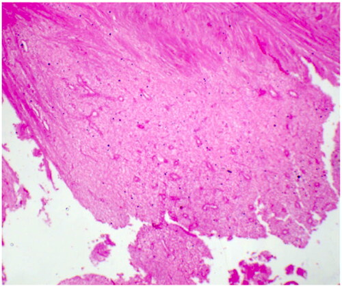 Figure 3. Necrotic tissue found in the uterine cavity during cesarean section.