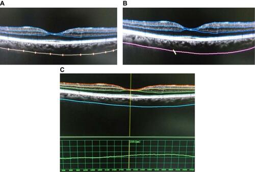 Figure 2 Measurement of choroidal thickness. (A) The sclero-choroidal interface is marked manually. (B) The line connects the marked points automatically by the software. (C) Measurement is done automatically between the outer choroid line and retinal pigment epithelium.
