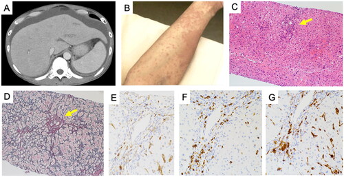 Figure 1. Abdominal CT, skin, and pathological findings of liver in our present case. At the time of acute liver failure, abdominal CT revealed the development of ascites (A), and skin erythema appeared around the same time (B). Hematoxylin-eosin (H&E) staining showed mild infiltration of inflammatory cells into lobules (arrow) (original magnification: x100) (C), and silver staining showed fibrous portal expansion (arrow) (original magnification: x100) (D). Immunostaining of CD4 (E), CD8 (F), and CD68 (G) revealed the dominance of CD8 or CD68-positive cell infiltration (original magnification: x200).