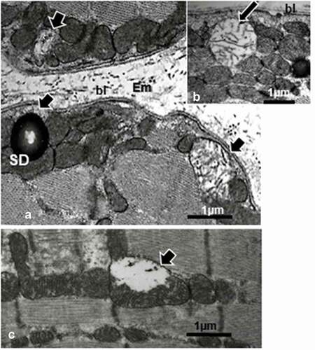 Figure 11. a-c: Typical mitolytic aspects or mitolysis in adult female obese Zucker rat tibialis anterior oxidative slow twitch (SO) and fast twitch or FOG muscle types. Profiles of sub-sarcolemmal (a-b) or intermyofibrillar (c) mitochondria revealed matrices either partially or entirely swollen-like degraded compared with other adjacent typical mitochondria profiles (white arrows). Highly contrasted SDs appear in both a and b. bl: basal lamina