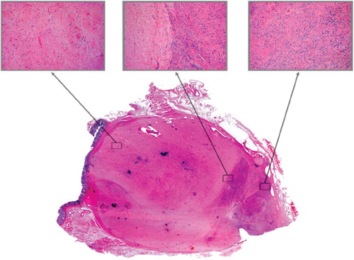 Figure 2. Hematoxylin and Eosin (H&E) staining of the tumour. Tumour appears heterogeneous, consisting of large areas of necrotic tissue and scattered spindle cells corresponding to good treatment response but also small areas with cellular rich tissue.