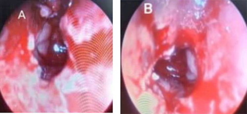 Figure 3 An endoscopic image of the choana during surgery (A) Right nasal passage (B) Left nasal passage.