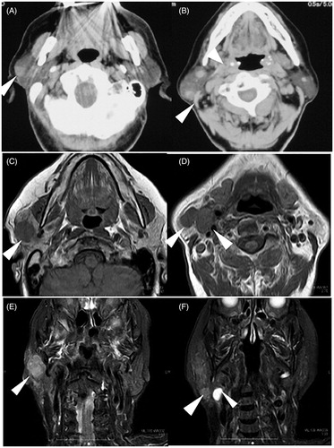 Figure 1. Contrast-enhanced CT findings at first visit and MRI findings 3 months after first visit. Contrast-enhanced CT at first visit showed one tumor in the upper end (A, arrowhead) and two tumors in the lower end (B, arrowhead) of parotid gland. MRI findings 3 months after the first visit showed enlarged tumors in axial section of T1 weighted intensity (C,D) and coronal section of T2 weighted intensity (E,F). Arrowheads indicate the tumors in the upper end (C,E) and the lower end (D,F) of parotid gland and superior deep lateral cervical lymph node (F).