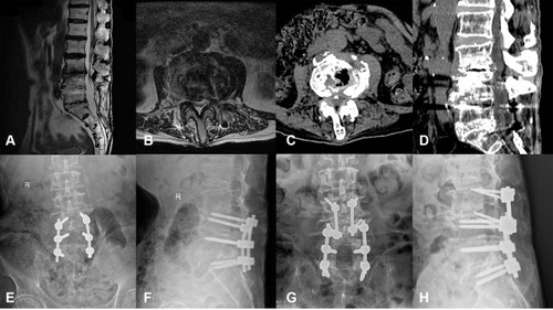 Figure 2 Case 1. A 77-year-old man with ASD of L3-4 underwent revision surgery with CBT screws assisted by a navigation template. (A–D) Preoperative MRI and CT scans revealed L3/4 intervertebral disc herniation and calcification. (E–H) His pre- and  postoperative X-ray showed the CBT screws as the fixation method for L3/4.
