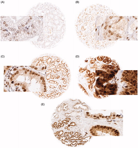 Figure 1. Representative pictures of (A) negative, (B) weak, (C) moderate and (D) strong RSF1 nuclear staining in prostate cancer and (E) in a mixed spot with normal glands in the upper half and cancerous glands in the lower half; magnification 100×, spot size 600 μm.