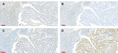 Figure 2 Detection of MMR protein expression by IHC. (A and B) Loss of MLH (A) and PSM2 (B) staining. (C and D) Intact MSH2 (C) and MSH6 (D) staining. Note the presence of nuclear staining in adjacent glands and benign stromal cells, validating the IHC method. Scale bars: 100 μm.