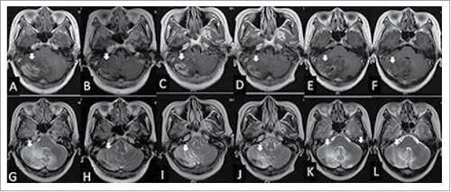 Figure 3. The woman was diagnosed with radiation brain necrosis for 1 year. Gadolinium-enhanced T1-weighted MRI in February 2015 showed widespread scattered irregular enhancement (A) and T2-weighted FLAIR MRI showed a large edema in the surrounding tissue (G). After bevacizumab treatment (3.27 mg/kg) in February 2015, the volume of necrosis (B) and edema (H) was reduced. Fifteen weeks after bevacizumab administration, gadolinium-enhanced T1-weighted MRI showed that the volume of necrosis (C) was enlarged and T2-weighted FLAIR MRI showed the edema (I) in the surrounding tissue was enlarged in June 2015, hence bevacizumab treatment (3.27 mg/kg) was given for the second time. At the July 2015 follow-up, the volume of necrosis in gadolinium-enhanced T1-weighted MRI (B) and edema in T2-weighted MRI (J) was reduced significantly again. In the October 2015 follow-up, the volume of necrosis in gadolinium-enhanced T1-weighted MRI (E) and edema in T2-weighted FLAIR MRI (K) was enlarged and the neurological symptoms were aggravated again; thus the patient was treated with bevacizumab (3.27 mg/kg) for the third time. Eight weeks after the third treatment of bevacizumab, the volume of necrosis in gadolinium-enhanced T1-weighted MRI (F) and edema in T2-weighted MRI (L) was reduced again.