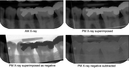 Figure 4. Subtraction imaging. The postmortem (PM) image is superimposed on the antemortem (AM) image and turned into a negative. When its opacity is reduced, the AM image becomes progressively more visible until all the overlying negative and underlying positive colours cancel to resolve to grey wherever the images are similar. Changed features now become clear. The suggestion of a white margin around the amalgam fillings indicates a slight mismatch in the sensor or beam alignment or both between the two images, demonstrating that they are the same object. (Image courtesy Health Support Queensland Forensic and Scientific Services (HSQ FSS) and the Queensland State Coroner, with permission).