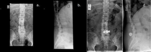 Figure 4 Preoperative and postoperative scans for one IFD participant: (a) preoperative A-P view, (b) preoperative lateral view, (c) postoperative A-P view, (d) postoperative lateral view.