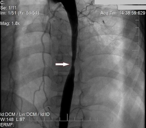 Figure 1 Aortic angiography demonstrates the location and dimensions of the aortic stenosis.