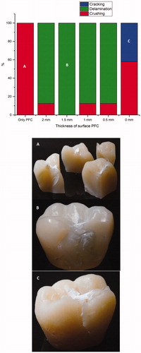 Figure 4. Percentage and photographs of various fracture patterns of the crown specimens. (A) Catastrophic crushing of particulate filler composite; (B) delamination of particulate filler composite from the fiber reinforced core; (C) cracking fracture in plain fiber reinforced composite.