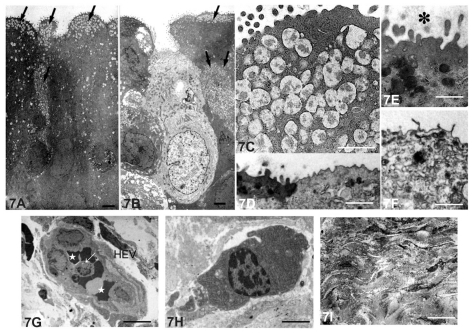 Figure 7 Electron micrographs of lacrimal sac epithelium and diffuse lymphoid tissue 3 months after Staphylococcus aureus inoculation. (A–F) Lacrimal sac epithelium. (A) The superficial epithelial cells were columnar and had accumulations of secretory granules (arrows) in the apical region of the dark epithelial cells. Bar = 3 μm. (B) Light cells were also present in the epithelium among the dark cells (arrows, secretory granules in dark cells). Bar = 3 μm. (C) The cored secretory granule aggregated in the apical region of the dark epithelial cells. Bar = 1 μm. (D) Microvilli were present on the apical region of the dark cells, whereas on the light cells they were poorly developed. Bar = 6 μm (E) The microvilli of the dark cells were embedded in an extracellular matrix (*). Bar = 1 μm. (F) Rudimentary microvilli were sparsely distributed on the light cells (arrows). Bar = 1 μm. (G–I) Inflamed diffuse lymphoid tissue in the lamina propria. (G) High endothelial venules (HEV) were present in the lamina propria. Leukocytes (arrow) and the erythrocytes (stars) were in contact with endothelial cells. Bar = 1 μm. (H) A small number of the plasma cells were present in the connective tissue. Bar = 0.3 μm. (I) Collagen fibers and fibrocytes were arranged transversely in the lamina propria. Bar = 1 μm.