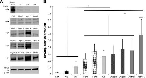 Figure 2 (A) Representative Western blots of uPAR protein in canine normal brain tissues and brain tumors. The numeral after each tumor type and grade indicates the specific sample depicted. (B) uPAR protein expression compared with β-actin concentrations in normal canine brain tissues and tumors.