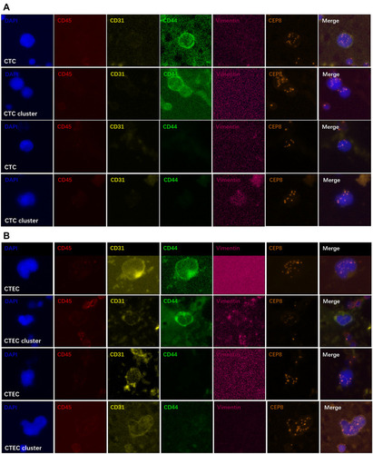 Figure 1 Detection of different subtypes of CTCs and CTECs expressing CD44 and vimentin in PDAC patients by SE-iFISH. (A) A CTC (DAPI+/CD45-/CD31-/vimentin-/CEP8+) has a positive expression of CD44; A CTC cluster (DAPI+/CD45-/CD31-/vimentin-/CEP8+) has a positive expression of CD44; A CTC (DAPI+/CD45-/CD31-/vimentin-/CEP8+) has a negative expression of CD44; A CTC cluster (DAPI+/CD45-/CD31-/vimentin+/CEP8+) has a negative expression of CD44. (B) A CTEC (DAPI+/CD45-/CD31+/vimentin-/CEP8+) has a positive expression of CD44; A CTEC cluster (DAPI+/CD45-/CD31+/vimentin+/CEP8+) has a positive expression of CD44; A CTEC (DAPI+/CD45-/CD31+/vimentin-/CEP8+) has a negative expression of CD44; A CTEC cluster (DAPI+/CD45-/CD31+/vimentin+/CEP8+) has a negative expression of CD44.