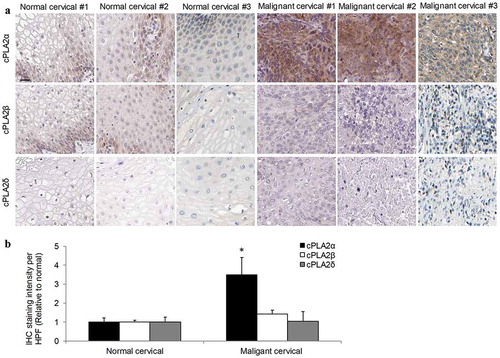 Figure 1. cPLA2α is specifically upregulated in cervical cancer tissues.