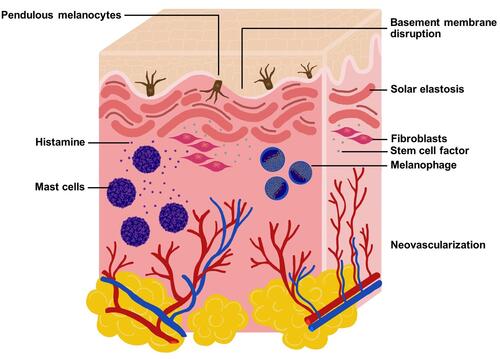 Figure 1 Diagram demonstrated pathologic changes in the dermis of lesional melasma including basement membrane disruption, pendulous melanocytes, melanophages, mast cells, stem cell factor, solar elastosis, and neovascularization.