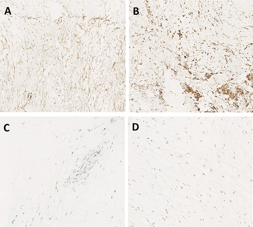 Figure 4 (A) Immunohistochemistry:Tumor spindle cells with diffuse positive CD34, (B) focal positive CD68, (C) negative S-100 and (D) KI-67 2%. (IHC * 40).