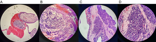 Figure 2 HE staining of primary lesion (ES-SCLC) in the first patient (A–D).