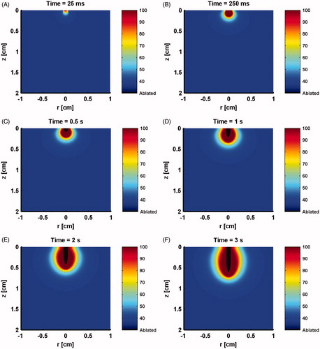 Figure 5. Longitudinal sections showing model predicted evolving temperature profile and ablation crater resulting from irradiation by a 50 W CW laser at times of: (A) 25 ms, (B) 250 ms, (C) 0.5 s, (D) 1 s, (E) 2 s, (F) 3 s.