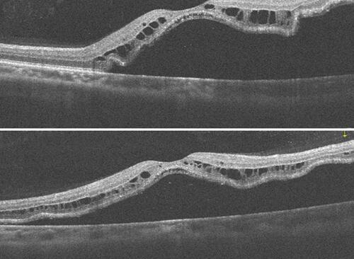 Figure 5 Rhegmatogenous retinal detachment involving the macula, and absent macular hole.
