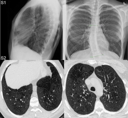 Figure 1. Chest X-ray and CT in adult survivors of bronchopulmonary dysplasia.