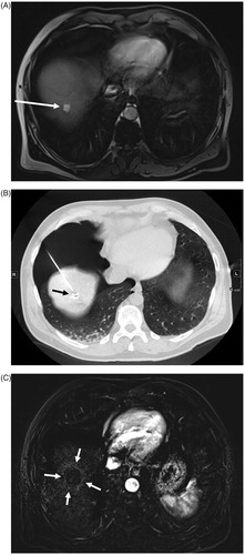 Figure 2. HCC (arrow) located in the dome (unvisible on US) on arterial T1-weighted MR image (A). PTA after HCC (arrow) tagging using lipiodol arterial injection and artificial CO2 pneumothorax (B). Follow-up 3 months after PTA showing the ablation zone (arrows) on subtraction T1-weighted MR image at the arterial phase (C).