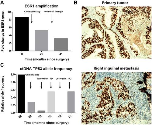 Figure 2 Amplification and overexpression of ESR1 in tumor samples from hepatic hilum and right groin. (A) The amplification of the ESR1 gene in tumor tissue samples at the indicated time. A decrease of ESR1 amplification in tumor tissue was observed after chemotherapy and hormonal therapy. Primary tumor and two right inguinal metastasis samples for next-generation sequencing were collected on Feb. 2016, Aug. 2018 and Aug. 2019 respectively. (B) Immunohistochemical staining of ESR1 in samples from the primary tumor (Mar. 2016) and right inguinal metastasis (Aug. 2018). (C) Change of allele frequency of TP53 in ctDNA of the patient. Patient’s ctDNA was sequenced at indicated time points, which were calculated as months since surgery on Mar. 2016. The allele frequency of TP53 gene was normalized to the sample at 27 months and compared with each other. PD represents the progressive disease.