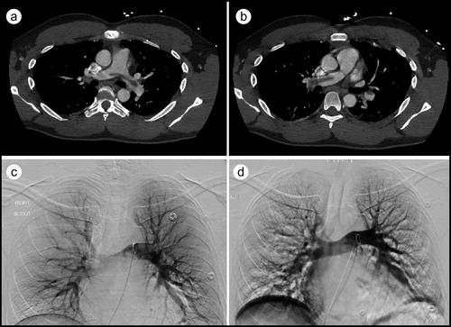 Figure 2. CT pulmonary angiography showing (a) a large saddle embolus and (b) extension of the saddle pulmonary embolus. (c) Pulmonary angiogram revealing lack of blood flow. (d) Restoration of blood flow in the pulmonary circuit after mechanical thrombectomy.