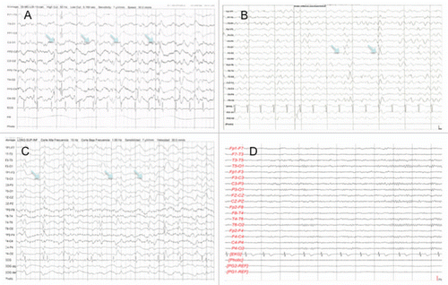 Figure 2 EEG of (A) Case4, (B) Case 5, (C) Case 6 and (D) control. In contrast to (D), figures (A–C) show triphasic waves (arrows) in a pseudoperiodic or periodic pattern.