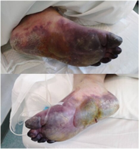 Figure 1. Ecchymosis in severe type of COVID-19 patients.