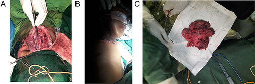 Figure 4 (A) Shows a complete excision of the mass with freed great vessels and vagus. Also note the hypoglossal nerve passing anterior to the bifurcation of the common carotid artery; (B) final appearance after completion of the surgery; (C) resected specimen.