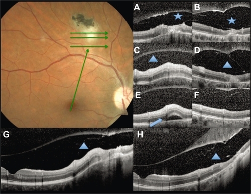 Figure 3 Baseline fundus photography. Green arrows show the scan acquisition protocol used by spectral domain optical coherence tomography. A, C, and E are from the volume scans at baseline, and G, a linear scan from the fovea to the lesion. B, D, F, and H correspond to the same points at follow up. Vitreoschisis (asterisk) can be noticed at baseline A) and after 6 weeks B). Note the expanded vitreous detachment at follow up. Subretinal fluid at the lesion site (arrowhead) is seen at baseline E) with resolution after 6 weeks F). The triangle shows the retinochoroidal lesion increased thickness at baseline (C, G) and atrophy at follow up (D, H).