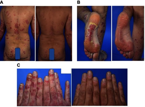 Figure 5 Case 4: psoriatic lesions on (A) the back and (B) the soles of the feet before and after 5 weeks on brodalumab, and (C) on the hands before and after 20 weeks on brodalumab.