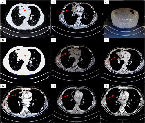 Figure 1. The clinical course according to CT scan findings: (A) (B) March 2022: a truncation observed in the medial segmental bronchus of the right middle lobe, accompanied by a distal mass-like soft tissue lesion; (C) March 2022: Osteolysis of the right iliac bone; (D) (E) April 2022: the constriction in the medial segmental bronchus of the right middle lobe has intensified. Therapeutic assessments indicate a progressive SD; (F) June 2022 chest CT: a reduction in the size of the pulmonary focus in the lung; (G): August 2022 chest CT, two months after starting osimertinib, showed a reduced right middle lobe tumor, evaluated as PR; (H) November 2022: PR observed two months after initiating aumornertinib; (I) PR on aumornertinib in february 2023.