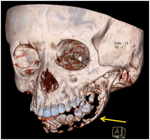 Figure 3. 3D reconstruction of facial CT showing mandibular resorption.
