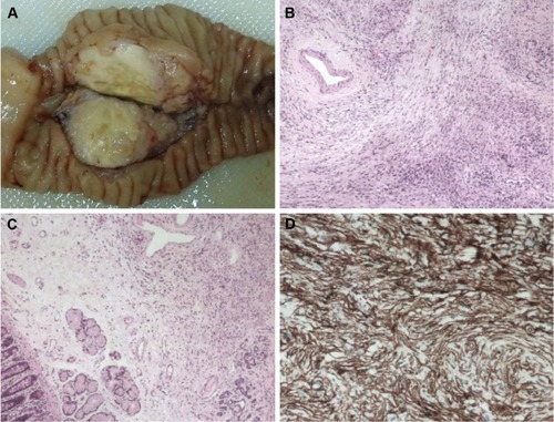Figure 2 Histopathology of the pancreatic tumor.