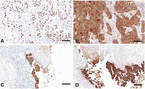 Figure 4 Immunohistochemistry assays suggested (A) positive P63, (B) positive CK5/6, (C) positive CK7, and (D) positive CK19 expression. The scale bars indicate 100 μm.