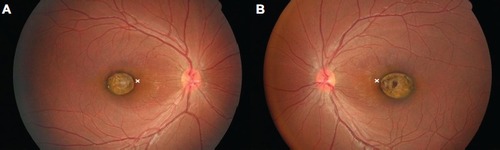 Figure 2 Fundus photographs taken at age 4 years and 1 month.