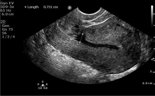 Figure 2 Cesarean scar defect by 2D ultrasound.